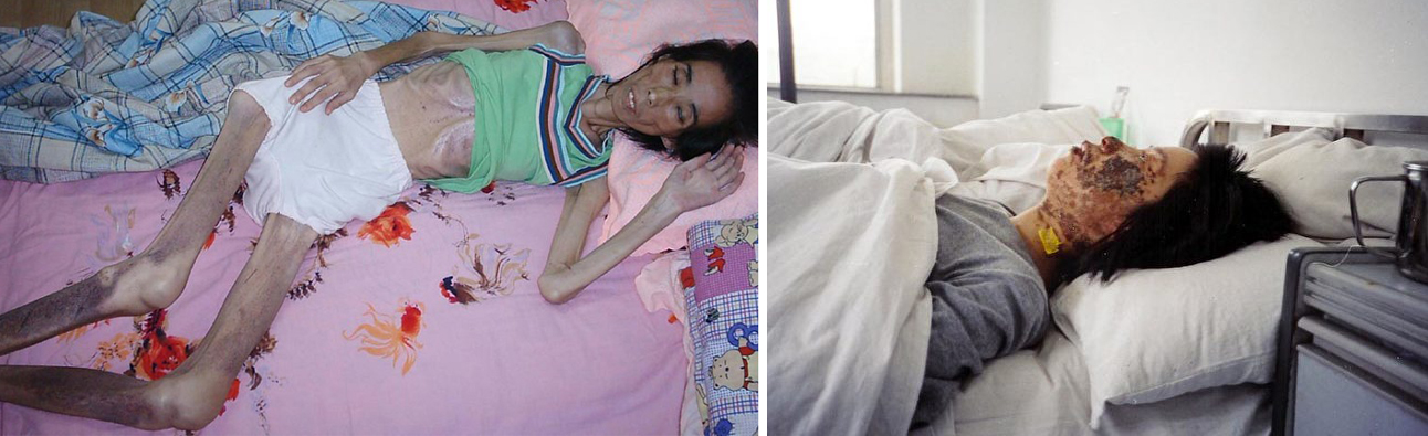 左圖 這不是當年被迫害的猶太人照片，而是在中國的法輪功練習者 右圖高蓉蓉，年輕的她，被酷刑折磨，臉上滿是電燒灼傷，最後傷重不治。